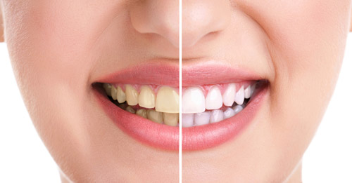 teeth-whitening-manchester