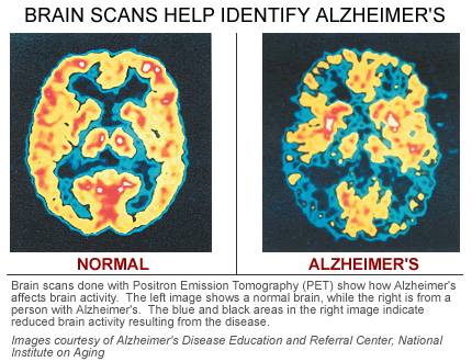 brain-scan Alzheimer's