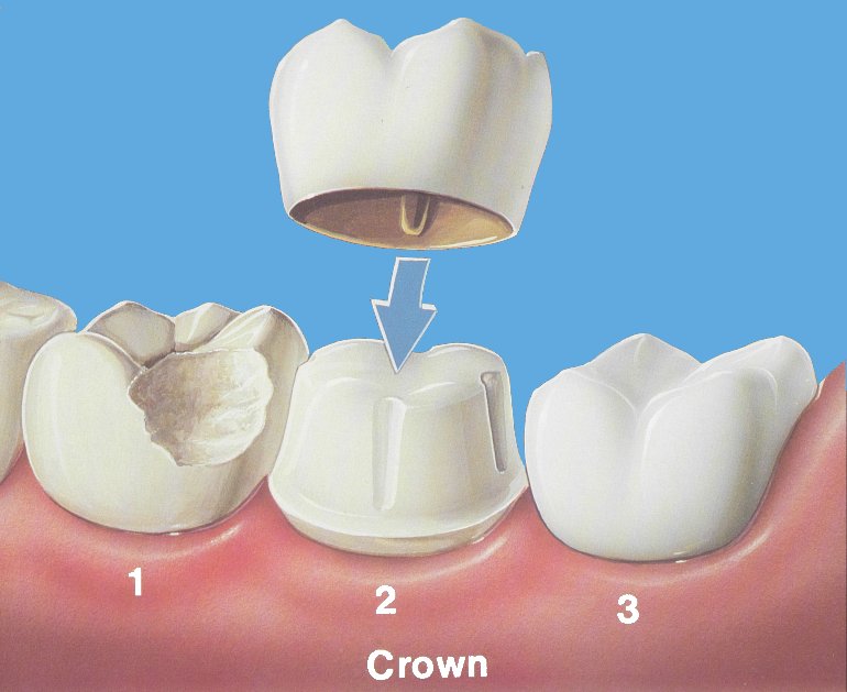 622899-dental-crown