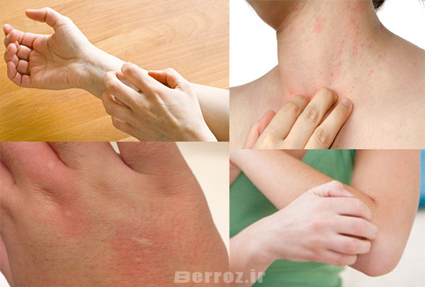 سروتونین عامل خارش پوست است | itchy skin