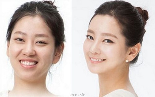 Cosmetic surgery (11)