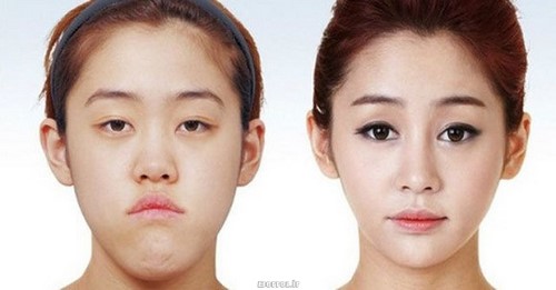 Cosmetic surgery - South Korea (1)