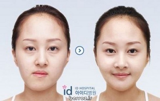 Cosmetic surgery South Korea (10)