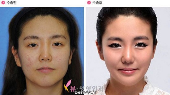 Cosmetic surgery South Korea (11)