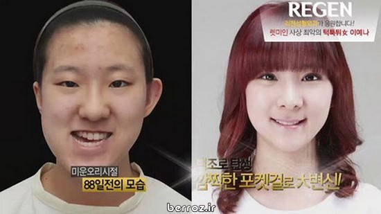 Cosmetic surgery South Korea (12)