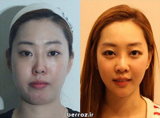 Cosmetic surgery South Korea (1)
