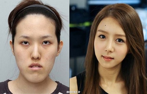 Cosmetic surgery - South Korea (3)