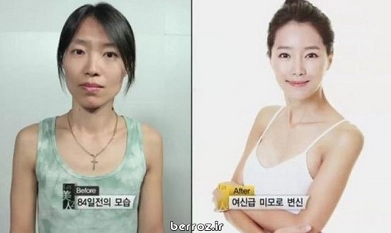Cosmetic surgery South Korea (3)