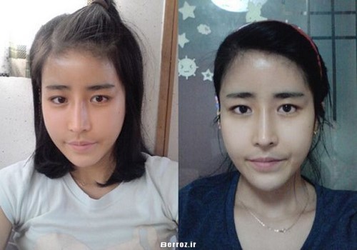 Cosmetic surgery - South Korea (4)