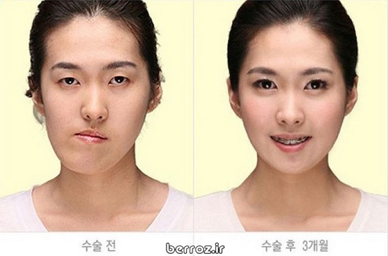 Cosmetic surgery South Korea (4)