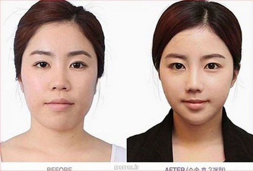 Cosmetic surgery - South Korea (5)
