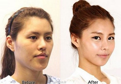 Cosmetic surgery - South Korea (6)