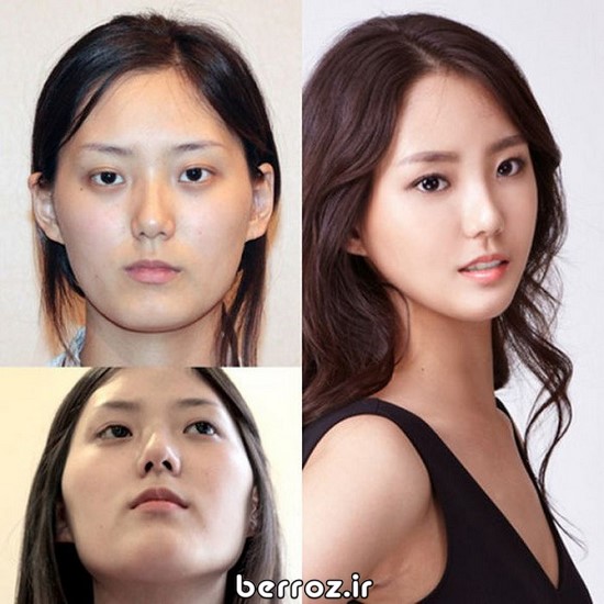 Cosmetic surgery South Korea (6)