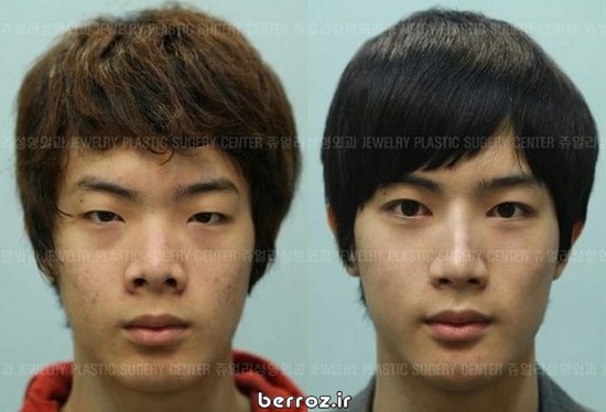 Cosmetic surgery South Korea (7)