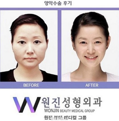 Cosmetic surgery - South Korea (8)