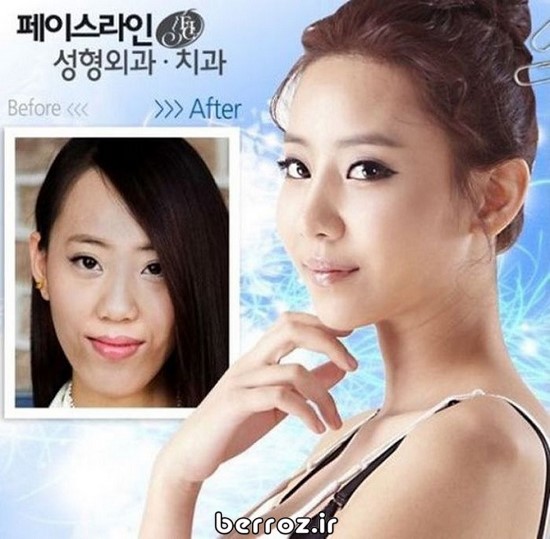 Cosmetic surgery South Korea (8)