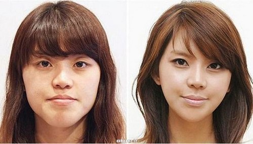 Cosmetic surgery - South Korea (9)