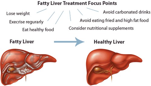Fatty Liver Treatment - درمان کبد چرب