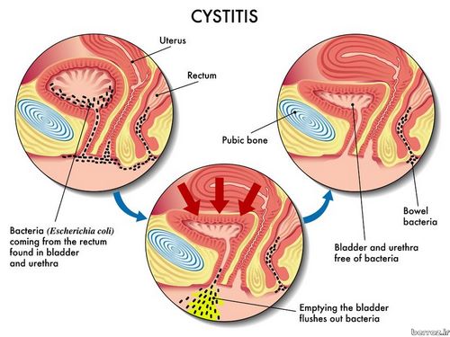 Cystitis - Urinary tract infection